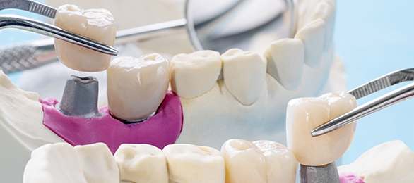 prodenco-dental-lab-fixed-restoration Fixed dental restoration