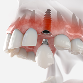 prodenco-dental-labs-experienced-laboratory-technicians-fixed-restorations Prodenco Dental Labs Fixed Restorations