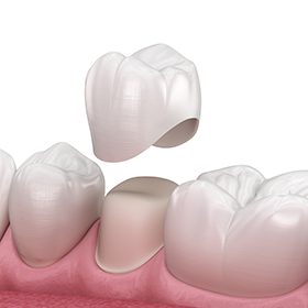 prodenco-dental-labs-fixed-restorations-technology Prodenco Dental Labs Fixed Restorations