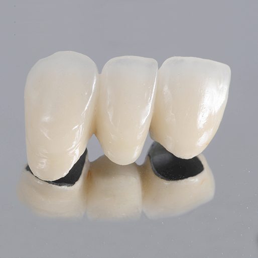 prodenco-dental-labs-porcelain-fused-metal-crowns-and-bridges Prodenco Dental Labs Porcelain Fused to Metal